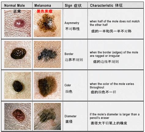 身上痣|痣也可能会癌变！长在 3 个地方要注意